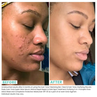 Thumbnail for Urban Skin Rx® Clear & Even Tone Clarifying Glycolic Pads, Exfoliates, Controls Oil & Shine, Clears Large Clogged Pores, Visibly Improves Blemishes & Post-Acne Marks, Fades Hyperpigmentation, 30 Ct