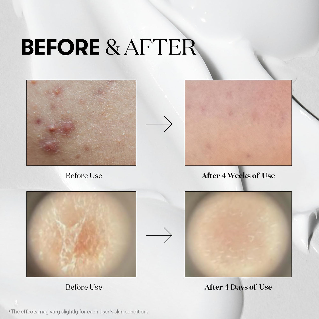 VT COSMETICS CICA Reedle Shot 700, Spicule Microneedling Serum for Pore Care&Exfoliation, Exosome&Centella Asiatica for Glass Skin, Acne&Blemish Care, Korean Liquid Skin Booster (1 Fl Oz / 30ml)