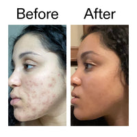 Thumbnail for The INKEY List Tranexamic Acid Serum, Helps Reduce Appearance of Skin Discoloration, Dark Spots and Uneven Patches, Healthy-Looking Skin Tone, 1 fl oz