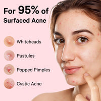 Thumbnail for Sosky Pimple Patches for Face, Invisible Hydrocolloid Acne Patches, HSA Store Eligible Items, Zit Sticker for Face and Skin, Pimple Sticker for Covering Zits, Blemishes with Salicylic Acid 48 Count