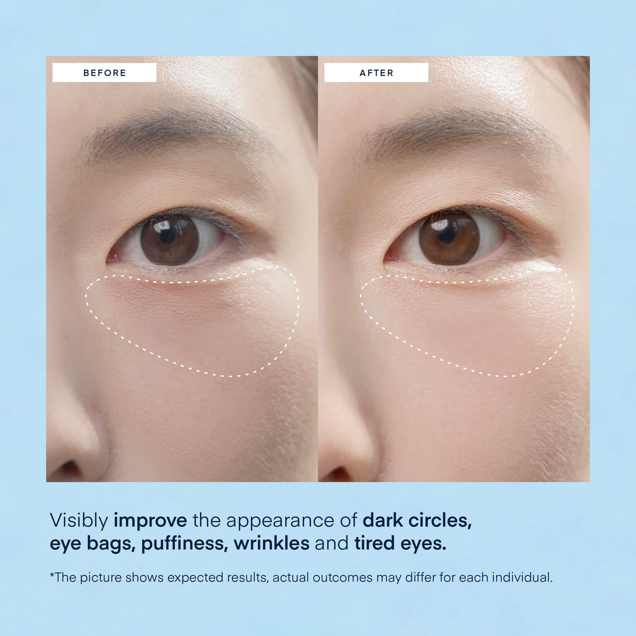 TEREZ & HONOR Under Eye Patches for Dark Circles - 60 Korean Hydrogel Masks for Puffiness, Bags with Caffeine, Hyaluronic Acid, Niacinamide - Undereye Brightening, Hydrating, Anti-Wrinkle & Cooling