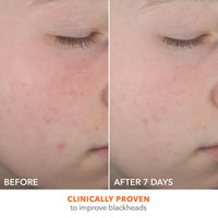 Thumbnail for Dr Dennis Gross Alpha Beta® On The Spot Eliminator, 2% Salicylic Acid Spot Treatment, 1 Fl Oz