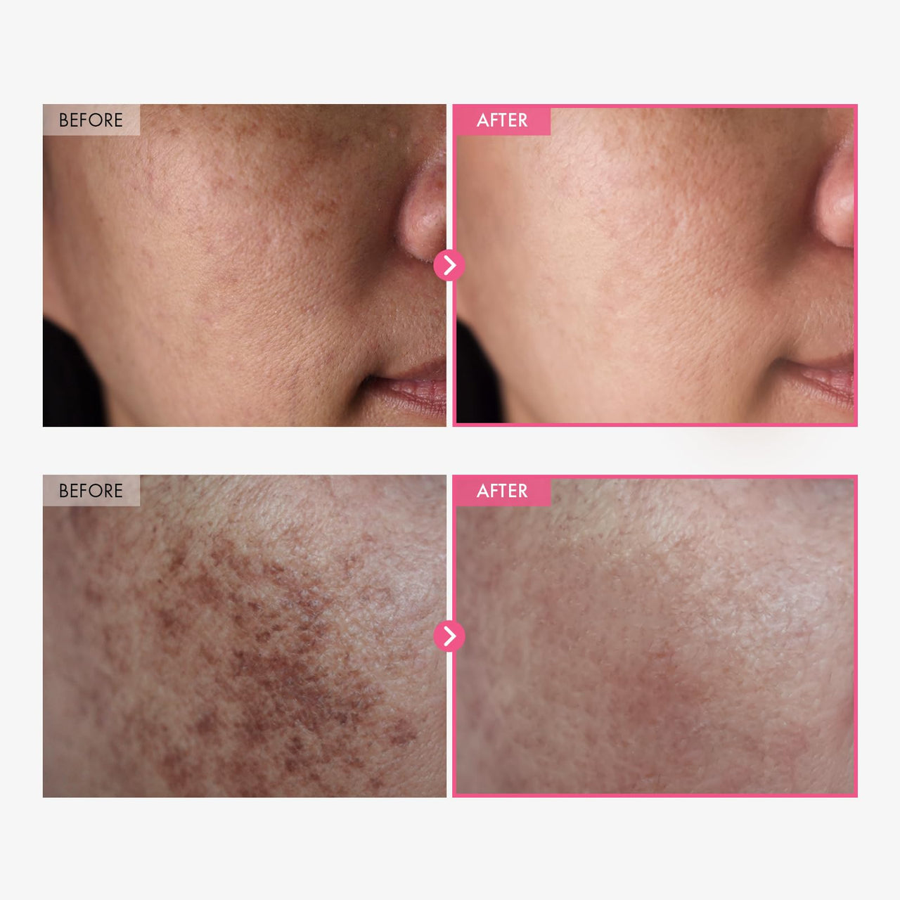 Buy TOSOWOONG Arbutin 7% + Tranexamic Acid 4% Cream, 70,000ppm Arbutin, 40,000ppm TXA, Niacinamide, Glutathione, Dark Spots, Freckle, Blemishes, Pigmentation, Korean Skin Care, 50ml, 1.69 fl.oz. Online - DistaUSA Buy TOSOWOONG Arbutin 7% + Tranexamic Acid 4% Cream, 70,000ppm Arbutin, 40,000ppm TXA, Niacinamide, Glutathione, Dark Spots, Freckle, Blemishes, Pigmentation, Korean Skin Care, 50ml, 1.69 fl.oz. Online - DistaUSA