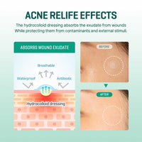 Thumbnail for SOME BY MI 30 Days Miracle Clear Spot Patch - Pack of 1, 18 Counts, 2 Size(10mm 9Counts, 12mm 9Counts) - Invisible Hydrocolloid Skin Trouble and Pimple Patch with No Irritation - Korean Skin Care