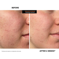 Thumbnail for Kate Somerville ExfoliKate Intensive Exfoliating Treatment – Salicylic Acid and Lactic Acid Super Facial Scrub and Mask, Improves Texture and Pores, 0.5 Fl Oz