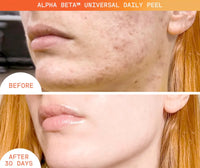 Thumbnail for Dr. Dennis Gross Alpha Beta Universal Daily Peel: for Uneven Tone or Texture and Fine Lines or Enlarged Pores, (5 Treatments)