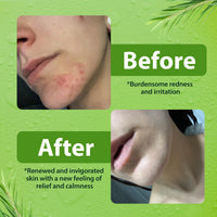 Thumbnail for Antibacterial Body Wash - Antibacterial Soap And Tea Tree Body Wash For Jock Itch, Athletes Foot, Eczema And Back Acne - Anti Bacterial Body Soap For Men And Women Safe For All Skin Types - 8 Oz
