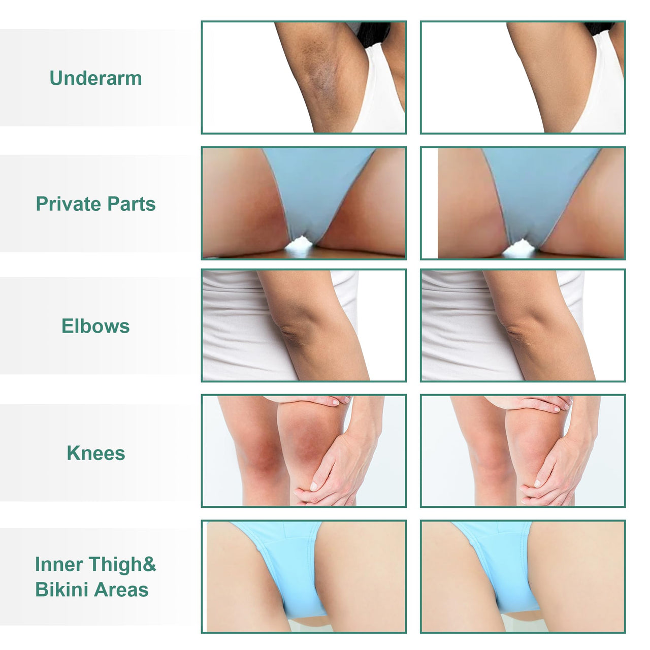 Vcetree Skin Bleaching Cream Skin Lightening for Body Intimate Areas, Private Parts, Underarm, Knees, Elbows, Inner Thigh, Bikini Area, Whitening Cream Dark Spot Remover For Intimate Areas (1FL OZ)