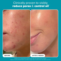 Thumbnail for Paula's Choice Skin Perfecting 2% BHA Liquid Salicylic Acid Exfoliant, Gentle Facial Exfoliator for Blackheads, Large Pores, Wrinkles & Fine Lines, Travel Size, 1 Fluid Ounce