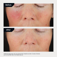 Thumbnail for Revision Skincare C+ Correcting Serum - Vitamin C Serum with 30% THD Ascorbate - Anti-Aging, Antioxidant Blend - Supports Healthy Skin, 0.5 fl oz