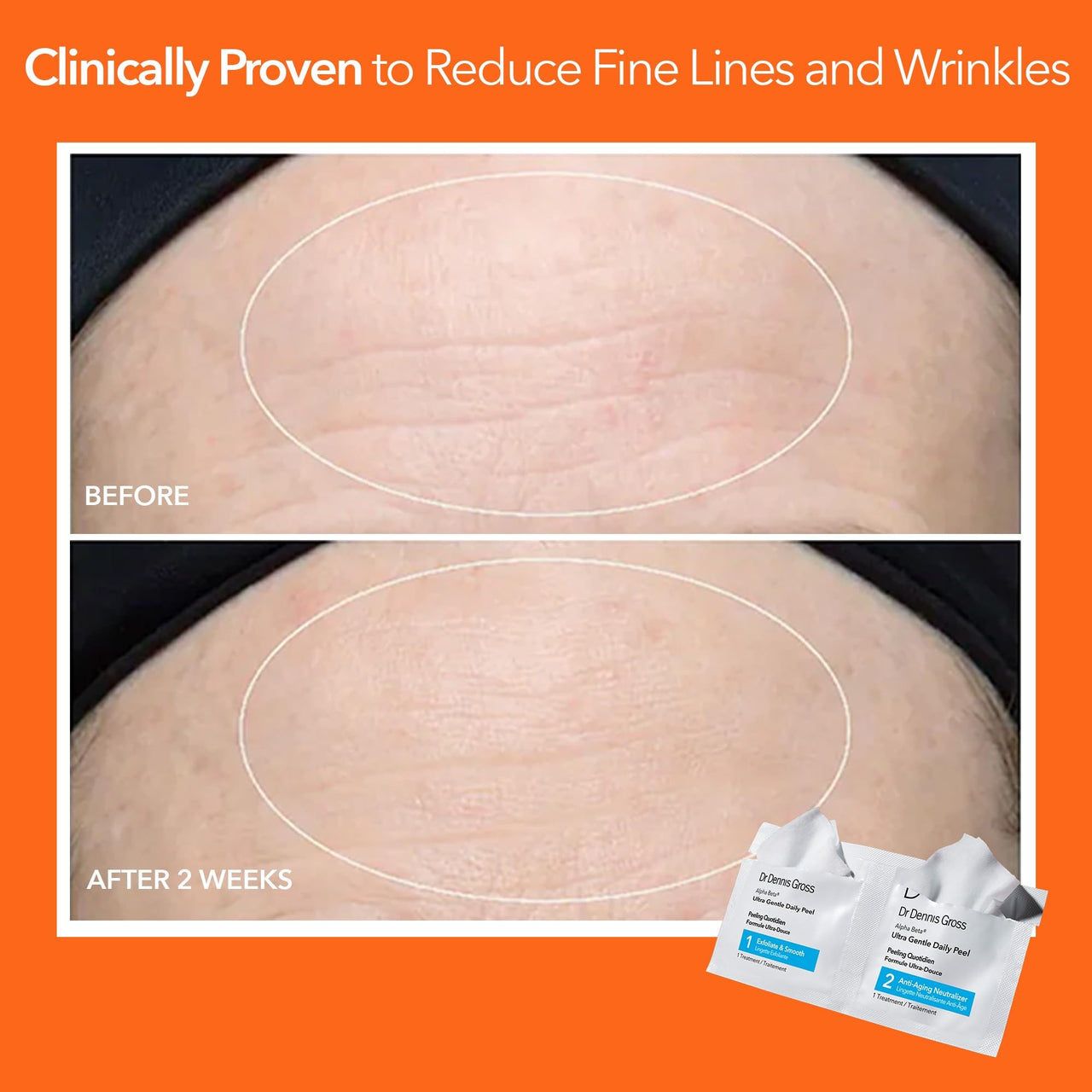 Dr. Dennis Gross Alpha Beta Ultra Gentle Daily Peel: for Dehydrated or Sensitive Skin, Uneven Tone or Texture, Fine Lines or Enlarged Pores (5 Treatments)