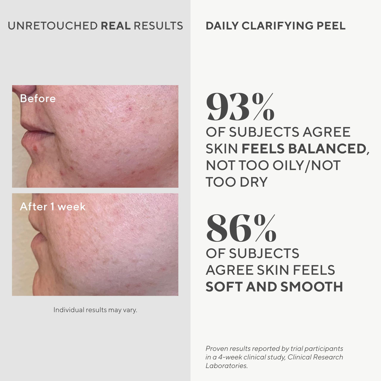 Murad Daily Clarifying Peel – Retinoid, Salicylic and Glycolic Acid, AHA/BHA Exfoliating Liquid Solution for Softer, Smoother, Hydrated, Pore-Refined Skin – 3.2 Fl Oz