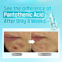 Thumbnail for numbuzin No.1 Serum | Pantothenic B5 Active Soothing Serum | Soothing, Hydrating | Pantothenic Acid, Niacinamide | Excess Oil Control, Reduces Breakouts, Acne | Oily, Acne-Prone Skin | 1.69 fl. oz.