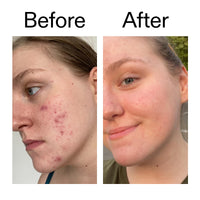 Thumbnail for The INKEY List 10% Glycolic Acid Toner 3.4 Fl Oz, Includes Witch Hazel, Pore Minimising Toner, Brightens Skin, Vegan Friendly, Suitable for Normal/Oily Skin