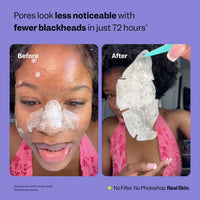 Thumbnail for Peach Slices - Nose Pore Patches (7 ct) - Overnight Blackhead Remover - Pore Strips - Absorbs Gunk - Thin, Flexible & Painless - Hydrocolloid Patches - Vegan & Cruelty Free - Korean Skin Care & Beauty