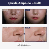 Thumbnail for TOSOWOONG Real Spicule Ampoule with 30,000 Shots, Niacinamide, Panthenol, Liquid Skin Booster Serum, Pore Minimizer, Exfoliating, Dead Skin Cells, Skin Texture, Korean Skincare, 30ml, 1.01 fl. oz.