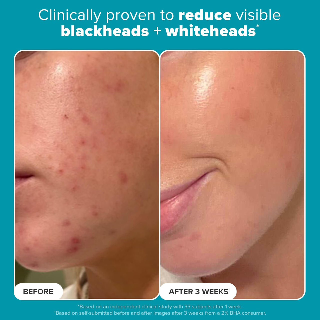 Paulas Choice--SKIN PERFECTING 2% BHA Liquid Salicylic Acid Exfoliant--Facial Exfoliant for Blackheads, Enlarged Pores, Wrinkles & Fine Lines, 4 oz Bottle