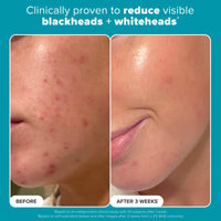 Thumbnail for Paulas Choice--SKIN PERFECTING 2% BHA Liquid Salicylic Acid Exfoliant--Facial Exfoliant for Blackheads, Enlarged Pores, Wrinkles & Fine Lines, 4 oz Bottle