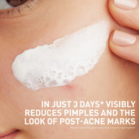 Thumbnail for CeraVe Clay To Foam Acne Face Wash, Multi-Use Salicylic Acid & Kaolin Clay Acne Spot Treatment Clears Pimples & Blackheads, Prevents Breakouts, Hydrates & Soothes, Fragrance-Free, Non-Comedogenic, 4oz