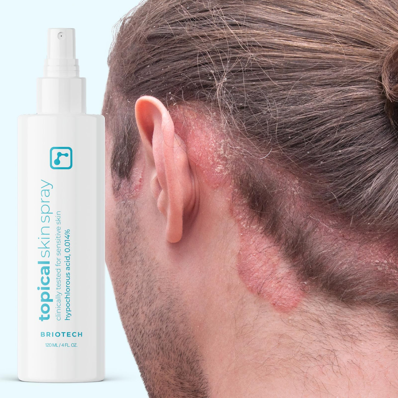 BRIOTECH Topical Skin Spray, Hypochlorous Acid Spray for Body & Face, Eyelid Cleanser, HOCl Facial Mist, Support Against Irritation and Redness, Packaging May Vary, 4oz (1 Pack)