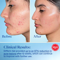Thumbnail for Differin Acne Treatment Gel, 90 Day Supply, Retinoid Treatment for Face with 0.1% Adapalene, Gentle Skin Care for Acne Prone Sensitive Skin, 45g Pump (Packaging May Vary)