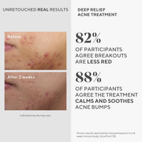 Thumbnail for Murad Deep Relief Acne Treatment - Maximum Strength Acne Treatment with 2% Salicylic Acid and Phytosteroid for Deep, Painful Acne Breakouts and Redness - Accelerated Healing Treatment - 1 Fl Oz