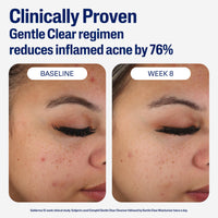 Thumbnail for Cetaphil Face Moisturizer, Gentle Clear Mattifying Acne Moisturizer With 0.5% Salicylic Acid, Hydrates and Treats Sensitive Acne Prone Skin, Skin Care for Sensitive Skin, 3oz