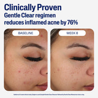 Thumbnail for Cetaphil Face Moisturizer, Gentle Clear Mattifying Acne Moisturizer With 0.5% Salicylic Acid, Hydrates and Treats Sensitive Acne Prone Skin, Skin Care for Sensitive Skin, 3oz