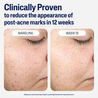 Thumbnail for CETAPHIL Gentle Clear Repairing Post-Acne Serum, Retinol Alternative, Oil Free Serum for Sensitive Skin, 1 Fl Oz, Bakuchiol, Improves Skin Tone & Post-acne Marks, Dermatologist Recommended Brand