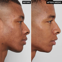 Thumbnail for The INKEY List Mandelic Acid Treatment, .5 fl oz