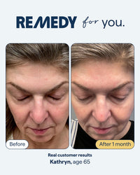 Thumbnail for Remedy for Healthy Aging - Retinal, Resveratrol, Glycolic Acid, Argireline, Ferulic Acid, Matrixyl 3000 - Anti-Aging Treatment for Wrinkles, Uneven Texture & Tone - By Dermatologist Dr. Shah