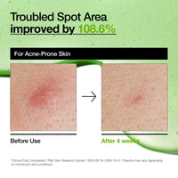 Thumbnail for Anua Azelaic Acid 10 Hyaluron Redness Soothing Serum, Facial Serum for Sensitive skin, Hyaluronic Acid, Niacinamide, Spot Care, Natural Color, Vegan, Korean Skincare (30ml/ 1.01 fl oz.)