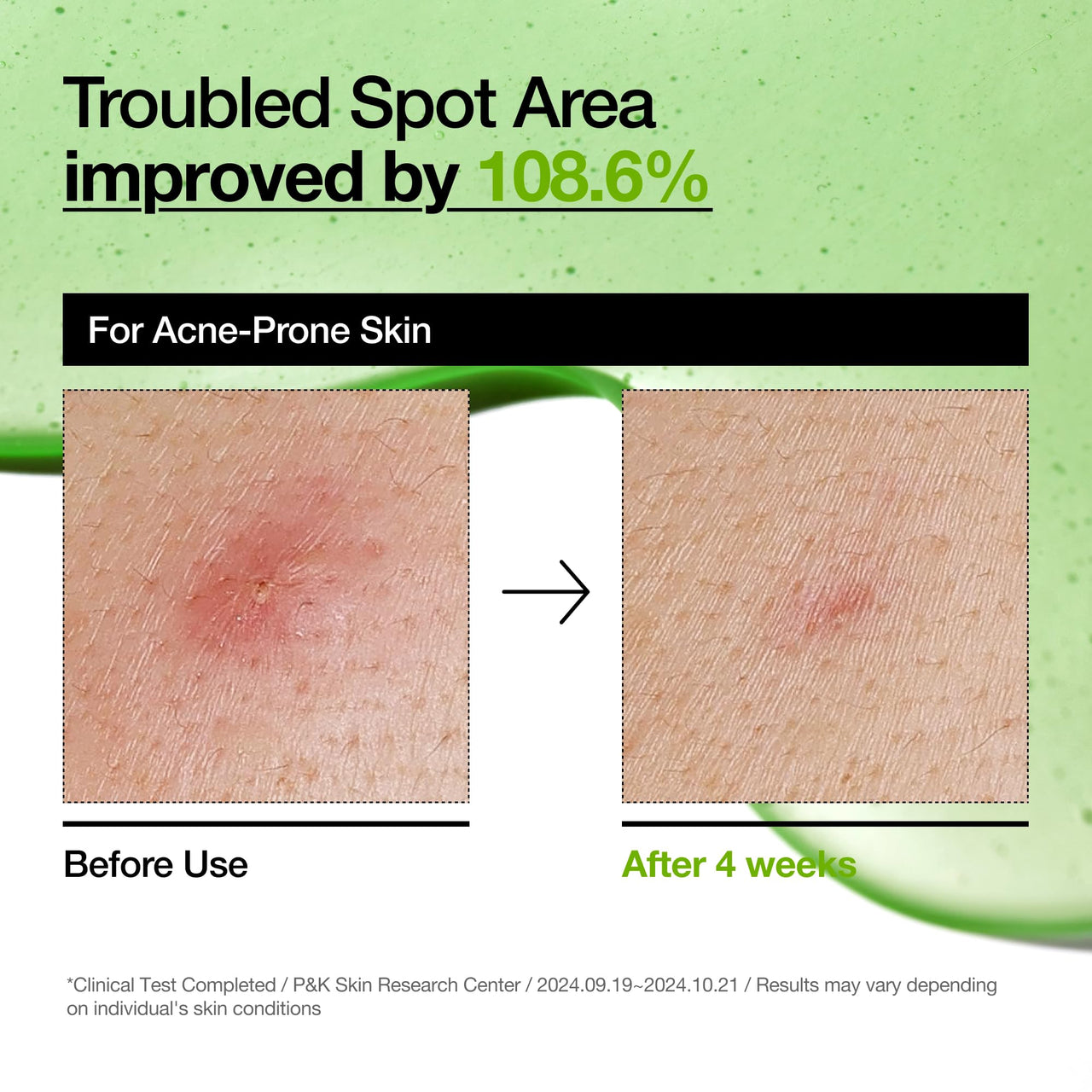 Anua Azelaic Acid 10 Hyaluron Redness Soothing Serum, Facial Serum for Blemish-Prone & Sensitive Skin, Lightweight & Hydrating Blemish Care, Hyaluronic Acid, Korean Skincare, 1.01 fl oz.