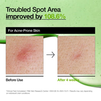 Thumbnail for Anua Azelaic Acid 10 Hyaluron Redness Soothing Serum, Facial Serum for Blemish-Prone & Sensitive Skin, Lightweight & Hydrating Blemish Care, Hyaluronic Acid, Korean Skincare, 1.01 fl oz.
