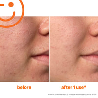 Thumbnail for Kate Somerville ExfoliKate Intensive Exfoliating Treatment – Salicylic Acid and Lactic Acid Super Facial Scrub Improves Texture and Pores, 2 Fl Oz