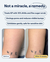 Thumbnail for Remedy KP Exfoliating Body Scrub | Keratosis Pilaris and Chicken Skin Treatment with Fine Sugar, Glycolic Acid, Lactic Acid and Squalane | Exfoliating Scrub | By Dermatologist Dr. Shah, 6.8 fl oz