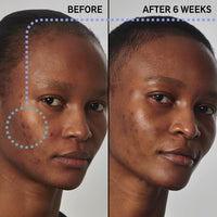 Thumbnail for The INKEY List SuperSolutions Niacinamide 20% Serum, Helps with Healthy-Looking Skin Texture, Pores and Balancing Excess Oil, Skin Barrier Protection 1.01 fl oz