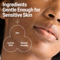 Thumbnail for Cetaphil Gentle Clear Complexion-Clearing BPO Acne Cleanser with 2.6% Benzoyl Peroxide, Creamy and Soothing for Sensitive Skin, Suitable for All Skin Types, 4.2oz