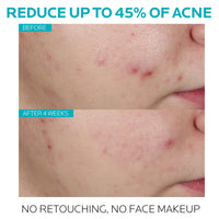 Thumbnail for La Roche-Posay Effaclar Salicylic Acid Treatment to Minimize Pores, Clear Acne Blemishes and Post Acne Marks