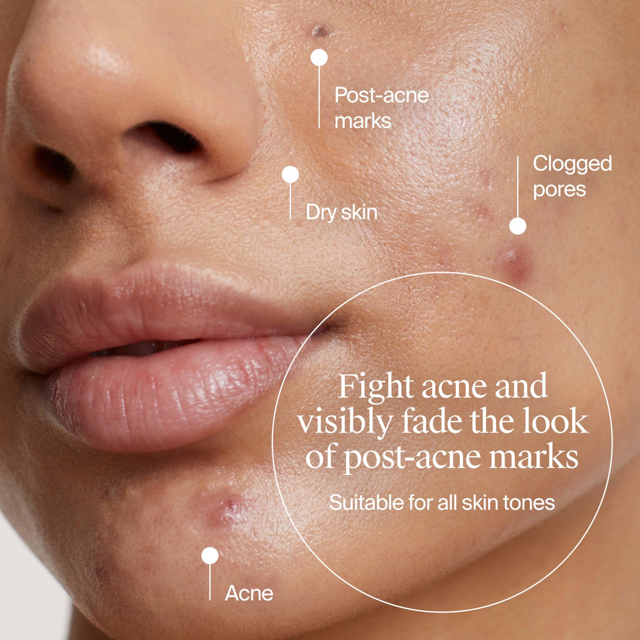 Neutrogena Evenly Clear Acne Gel Moisturizer with Salicylic Acid & N-Acetyl Glucosamine, Lightweight Non-Greasy Face Moisturizer Helps Treat Breakouts & Visibly Fade the look of Post-Acne, 1.7 fl. oz