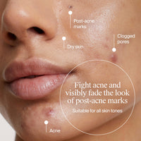 Thumbnail for Neutrogena Evenly Clear Acne Gel Moisturizer with Salicylic Acid & N-Acetyl Glucosamine, Lightweight Non-Greasy Face Moisturizer Helps Treat Breakouts & Visibly Fade the look of Post-Acne, 1.7 fl. oz