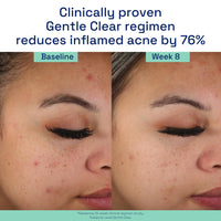 Thumbnail for Cetaphil Acne Face Wash, Gentle Clear Clarifying Acne Cream Cleanser with 2% Salicylic Acid, Deep Cleans & Treats Acne Prone Skin, Skin Care for Sensitive Skin, 4.2oz
