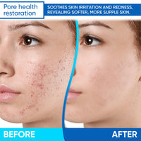 Thumbnail for AOBBIY Azelaic Acid Cream for Face: Redness-Soothing Azelaic Acid Facial Cream for Uneven Tone, Blemish-Prone Skin, Pore Care, and Skin Clarity Support, 4 oz