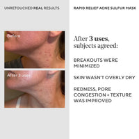 Thumbnail for Murad Rapid Relief Acne Sulfur Mask – Clay Mask with Salicylic Acid, 5% Sulfur, and Austrian Peat Reduces Oil, Minimizes Breakouts, Reduces Pimple Size, and Unclogs Pores – 2.5 Fl Oz