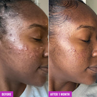 Thumbnail for Good Molecules Acne Foaming Cleanser - 2% Salicylic Acid Foam Cleanser - Gentle Acne Face Wash with Alcohol Free Witch Hazel and Aloe - Skin Care for Face