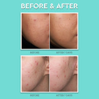 Thumbnail for Bliss Clear Genius Acne Spot Treatment – Maximum Strength 2% Salicylic Acid Shrinks Blemishes – Clean, Vegan, Cruelty-Free, 0.5 Fl Oz