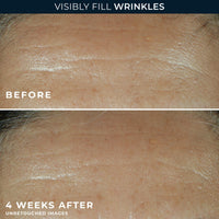 Thumbnail for RoC Retinol Correxion Wrinkle Filler for Deep Wrinkles with Hyaluronic Acid & Retinol, Skin Care for Women and Men, 1 Fl Oz (Packaging May Vary)