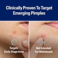 Thumbnail for Cetaphil Acne Patches, Pimple Patches for Sensitive Skin, Formulated with Salicylic Acid, CICA, and Heartleaf Extract for Emerging Pimples, Visible Results in 6 Hours, 24 Count