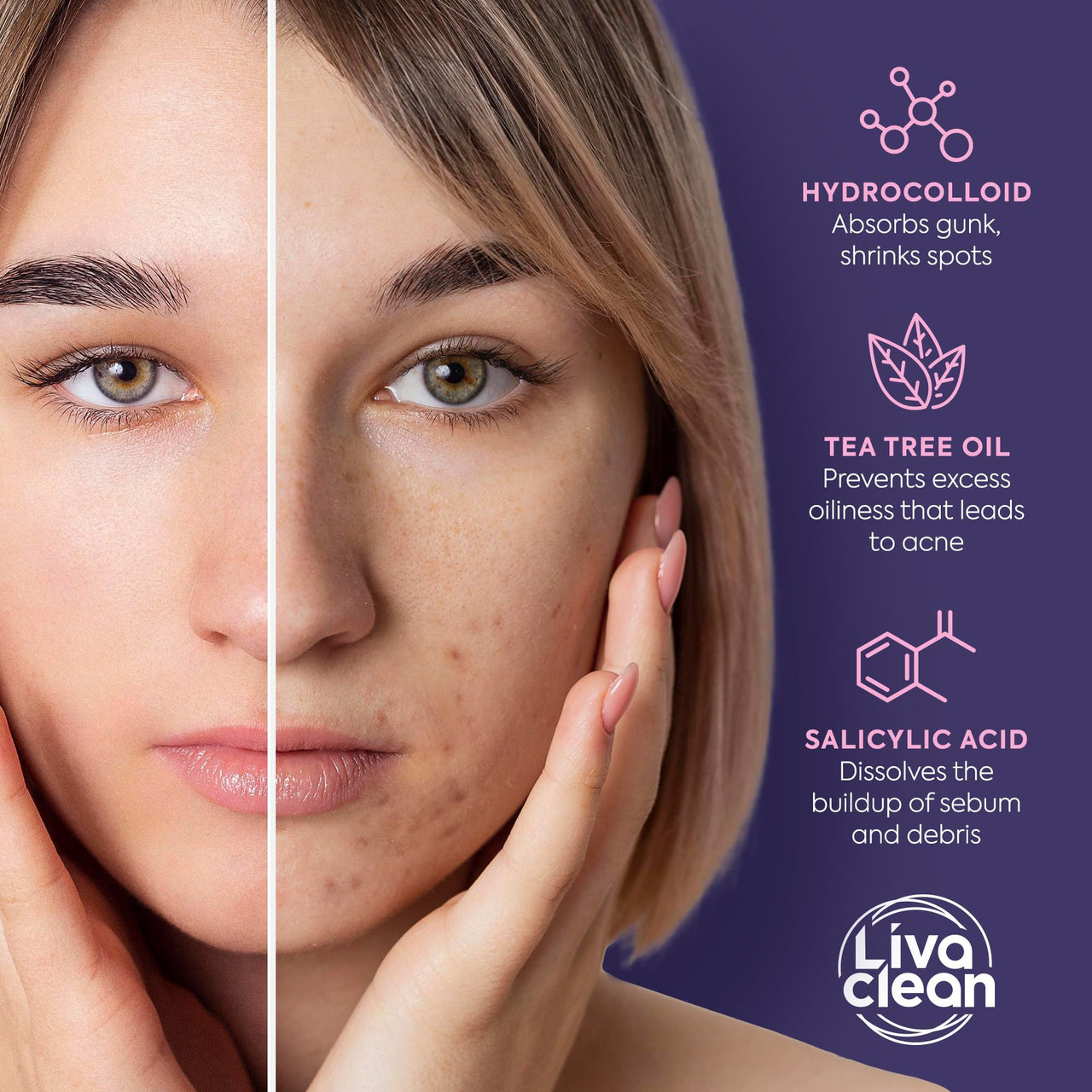 LivaClean Star Pimple Patches for Face w/Hydrocolloid, Salicylic Acid & Tea Tree, 240 Patches, Hydrocolloid Acne Patch, Cute Star Pimple Patch for Healing Stickers Zit Superstar