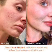 Thumbnail for Dr. Dennis Gross Alpha Beta Extra Strength Daily Peel: for Oily Skin, Uneven Tone or Texture, Wrinkles or Enlarged Pores (30 Treatments)